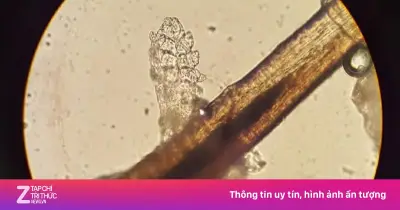 Cảnh báo: Hơn 60 con rận ký sinh trong mí mắt sau khi nối mi dịp Tết