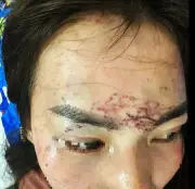 Cà Mau: Chủ cơ sở thẩm mỹ dùng kim xăm lên mặt 'tình địch' vì ghen tuông