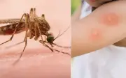 Côn trùng đốt: Nhận diện, xử trí và phòng ngừa dị ứng nguy hiểm