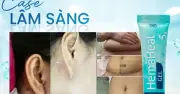 Gel HemaHeal: Giải pháp lành thương hiệu quả từ châu Âu