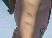 Nữ sinh lớp 5 ở Cà Mau bị chị họ rạch tay nhiều lần do mâu thuẫn, không khởi tố vụ án