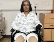 Người phụ nữ mất tứ chi sau khi bị chó liếm vết thương, cảnh báo nguy hiểm nhiễm trùng huyết