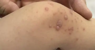 Bộ Y tế họp khẩn về tay chân miệng, vắc xin EV71 dự kiến về Việt Nam cuối 2026