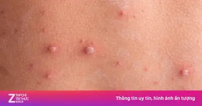 Bệnh thủy đậu: Dấu hiệu, cơ chế lây lan và biện pháp phòng ngừa hiệu quả