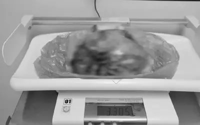 Phú Thọ: Phẫu thuật thành công khối u xơ tử cung khổng lồ tương đương thai 7 tháng