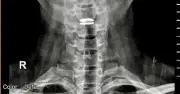 Bệnh nhân thoát vị đĩa đệm cổ được thay đĩa đệm nhân tạo, thoát nguy cơ liệt