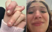 Cô gái Mỹ suýt mất ngón tay vì thói quen cắn móng tay tưởng vô hại