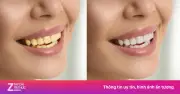 Cải thiện răng ị ố vàng hiệu quả: Nguyên nhân và giải pháp không dùng thuốc