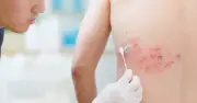 Hơn 90% Người Trưởng Thành Mang Virus Gây Bệnh Zona, Nguy Cơ Tăng Cao Ở Nhóm Bệnh Mạn Tính