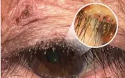Đi khám vì cộm và ngứa mắt, bất ngờ phát hiện rận mu bám chi chít trên lông mi