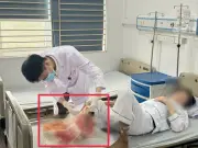 Người đàn ông suýt mất chân sau một tháng tự đắp lá chữa bỏng tại nhà