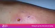 Người đàn ông thoát chân nhờ cứu kịp thời khi bị vi khuẩn ăn thịt tấn công từ vết thương nhỏ
