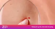 Nốt ruồi đỏ xuất hiện đột ngột: Dấu hiệu bệnh lý hay chỉ là lão hóa?