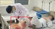 Đắp lá chữa bỏng suốt một tháng, người đàn ông suýt mất chân vì hoại tử xương