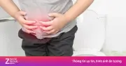 Sa trực tràng 10 cm sau Tết vì táo bón do ăn uống thừa đạm, ít vận động