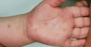 TP HCM: Bệnh tay chân miệng tăng mạnh từ tuần 9/2026, xuất hiện chủng virus nguy hiểm