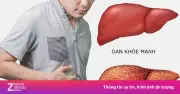 Ung Thư Gan Gia Tăng: Cảnh Báo Từ Virus Viêm Gan Và Lối Sống Không Lành Mạnh