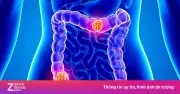 Ung thư đại trực tràng: Kẻ giết người số một ở người trẻ dưới 50 tuổi tại Mỹ