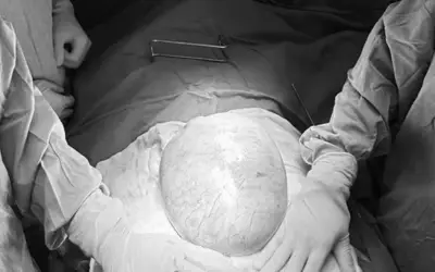 Bé gái 13 tuổi mang khối u buồng trứng nặng 4kg được phẫu thuật thành công tại TP.HCM