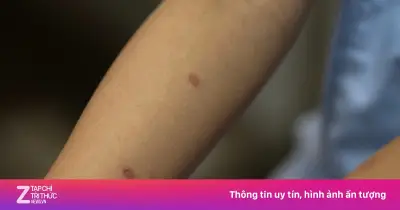 Bé gái 14 tuổi mắc nấm da nặng sau khi chơi với mèo, cảnh báo sai lầm khi tự ý dùng thuốc