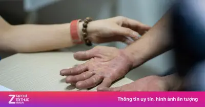 Bệnh da liễu tăng vọt đầu hè, bác sĩ cảnh báo nguy cơ từ nắng nóng và môi trường