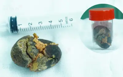 Bệnh viện Gia An 115 lấy sỏi mật to như quả trứng gà cho bệnh nhân nữ