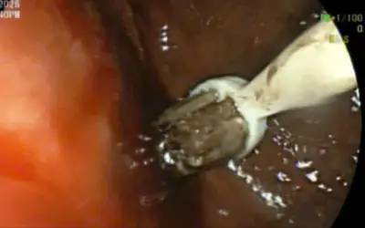 Bệnh viện Trung ương Huế can thiệp thành công cứu bệnh nhân nuốt 3 bàn chải đánh răng