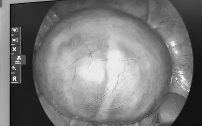 Bệnh viện Việt - Hàn Đà Nẵng phẫu thuật thành công khối u nang buồng trứng lớn 14cm