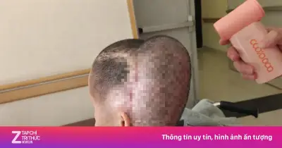 Cô gái 33 tuổi đột quỵ, biến dạng đầu sau khi cấy mỡ tự thân tại phòng khám tư