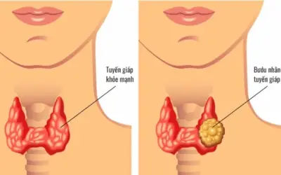 Chủ quan với nhăn tuyến giáp, người phụ nữ trẻ đi khám phát hiện 13 hạch di căn