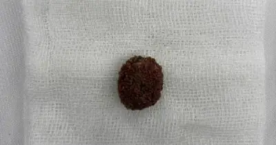 Cảnh báo từ bác sĩ: Tin quảng cáo thuốc tan sỏi trên mạng, bệnh nhân suýt mất thận