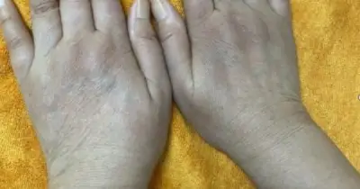 Cảnh báo từ bệnh nhân 68 tuổi: Dấu hiệu lạnh tay vô hại hóa ra là bệnh hiếm nguy hiểm