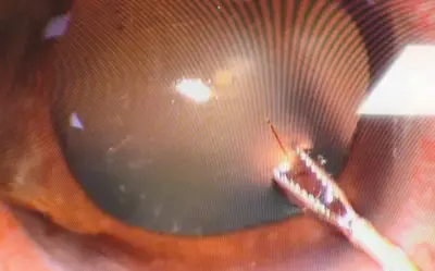 Cấp cứu bệnh nhân 37 tuổi bị ong ruồi chích xuyên giác mạc