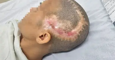 Cứu sống bệnh nhân đột quỵ hiếm gặp sau phẫu thuật thẩm mỹ hút mỡ