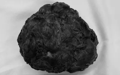 Du học sinh 24 tuổi phẫu thuật thành công khối u vú khổng lồ 18 cm tại Hà Nội