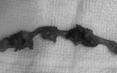 Đồng Nai: Phẫu thuật thành công ca nang niệu rốn hiếm gặp, bác sĩ cảnh báo biến chứng nguy hiểm