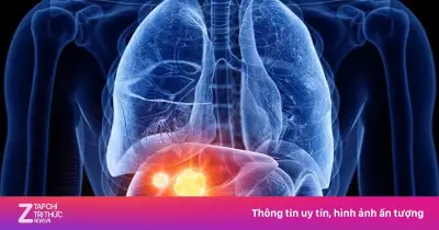 Ngứa kéo dài tưởng dị ứng, người đàn ông bất ngờ phát hiện ung thư gan