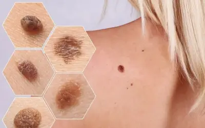 Phụ nữ phát hiện ung thư hắc tố ở cơ quan sinh dục từ dấu hiệu dễ bỏ qua sau mãn kinh