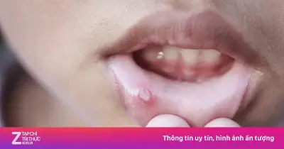 Từ nốt loét nhỏ tưởng nóng trong, người đàn ông 41 tuổi phát hiện ung thư lưỡi ác tính