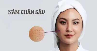 Top 5 Kem Mờ Nám Chân Sâu Hiệu Quả Cao, Đáng Đồng Tiền Bát Gạo