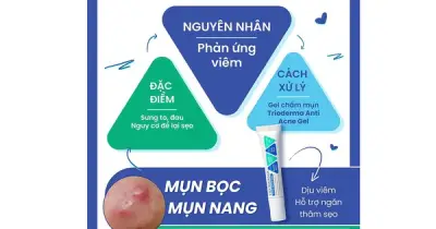Trioderma Anti Acne Gel: Giải Mã Hiệu Quả Thực Sự Với Mụn Bọc Sau 4 Tuần