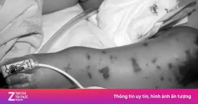 Viện Pasteur TP.HCM cảnh báo bệnh não mô cầu gia tăng cục bộ tại Đông Nam Bộ