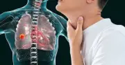 5 dấu hiệu ung thư phổi dễ bỏ qua: Thay đổi giọng nói, sụt cân, mệt mỏi kéo dài