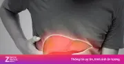6 dấu hiệu cảnh báo gan nhiễm mỡ nhiều người bỏ qua
