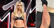 Ca sĩ Taylor Momsen nhập viện cấp cứu sau khi bị nhện độc cắn tại buổi diễn
