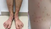 Cảnh báo bọ chét tấn công: Nhiều bệnh nhân ngứa dữ dội, tự điều trị sai cách