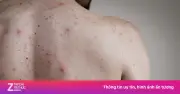 Nam thanh niên nổi ban lạ toàn thân, bất ngờ phát hiện mắc giang mai nguy hiểm