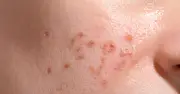 Sẹo rỗ: Tại sao cùng liệu trình nhưng kết quả lại khác nhau?