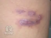 Thái Lan Ban Hành Cảnh Báo Khẩn Cấp Về Bệnh Sốt Đất