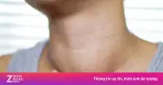 Ung thư tuyến giáp tăng nhanh: Cảnh giác với các dấu hiệu bất thường ở vùng cổ